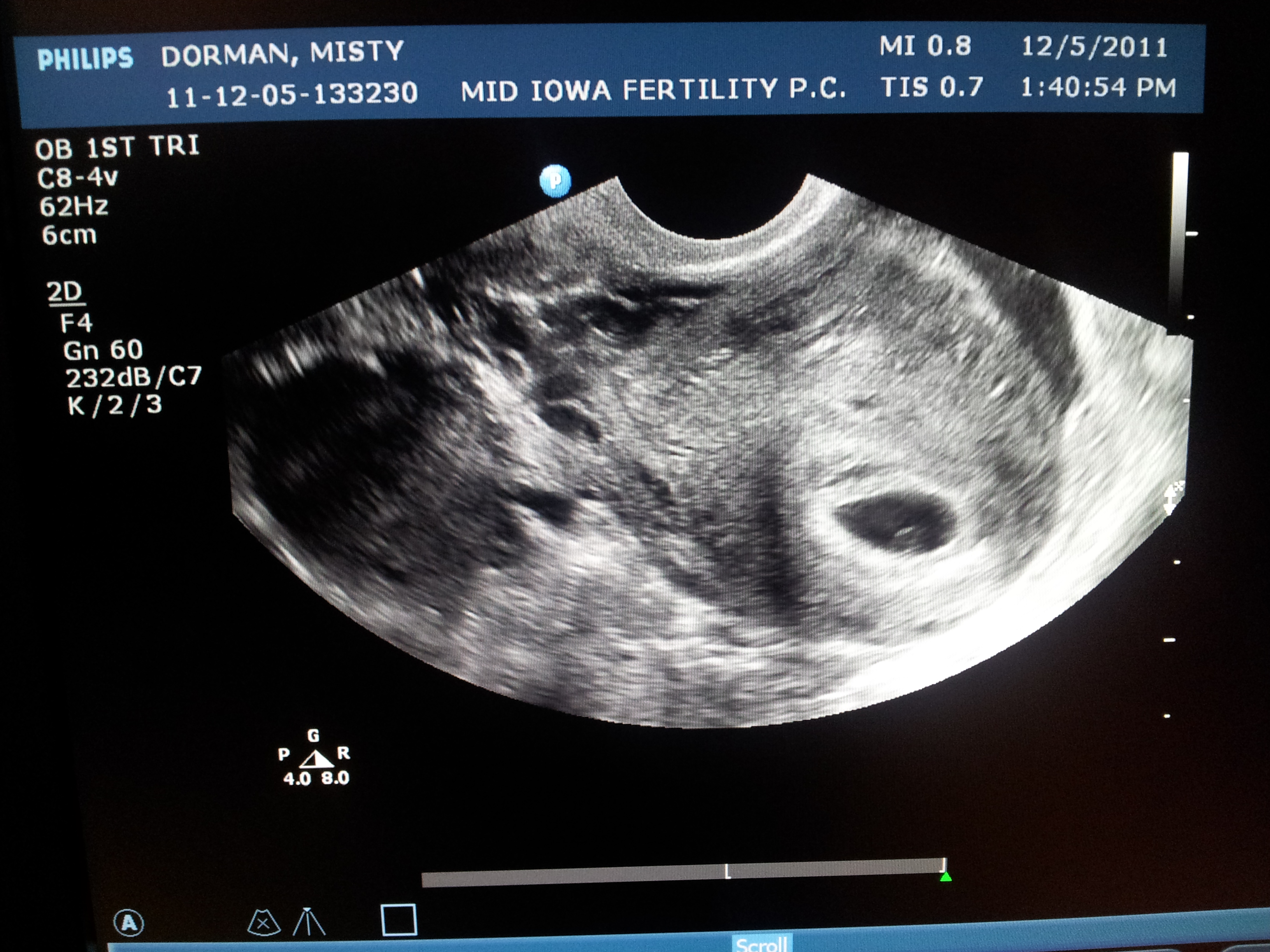9 недель беременности размер плода. Снимки УЗИ на 9 неделе беременности.